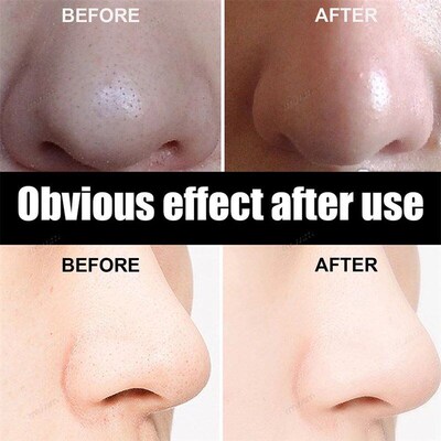 New 10-100pcs Unisex Blackhead Remove Mask Peel Nasal Strips