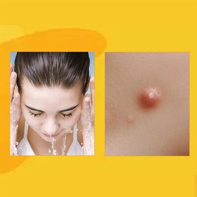 Revitalize Your Skin With Ximonth Bee Venom Spray For Wart