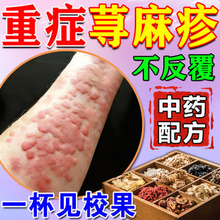 寻荨麻疹过敏止痒膏断非膏根专用皮肤过敏非膏药贴皮肤瘙痒免疫力