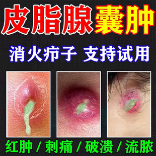 屁股火疖子拔毒拔脓膏脓包硬块效粉瘤皮脂腺特囊肿膏否中药敷料贴