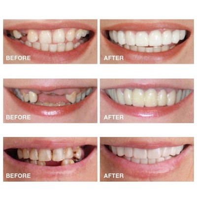 Upper/Lower Cosmetic Cosmetic Teeth Veneer Dentures for