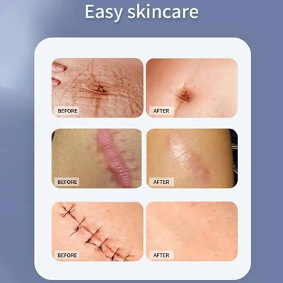 Silicone Scar Tape 1.57x19 Inches Invisible Silicon gel Scar