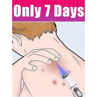 Generaton-2 Laser Says Goodbye To all warts n 7 Days