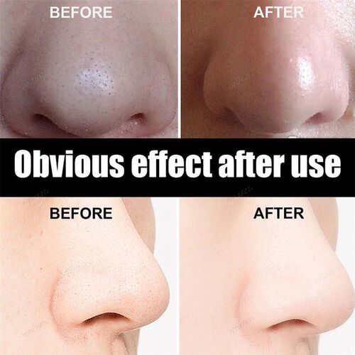 New 10-100pcs Unisex Blackhead Remove Mask Peel Nasal Strips