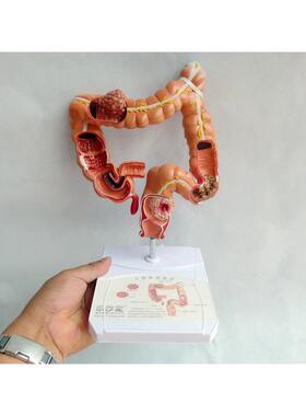 人结肠病变模学型肛肠科消化体内QYR大肠模型科医人体解剖学
