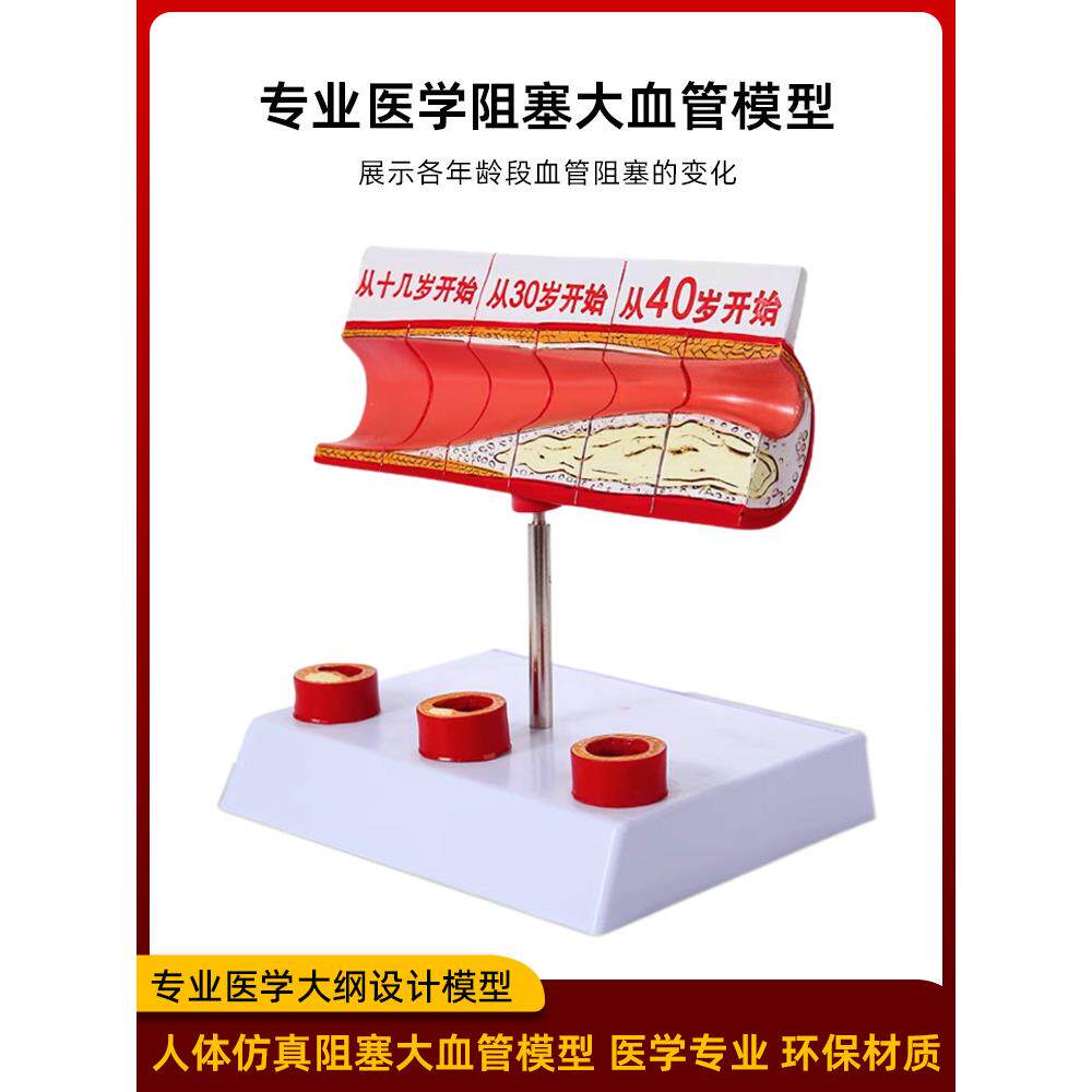 心脑血管阻塞模型关节血栓血浓脂病理粥型硬化人体解剖教具