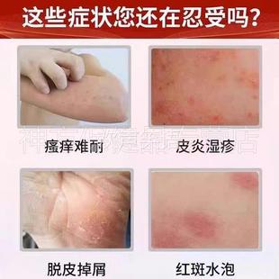 葵花皮肤修复液止痒皮肤瘙痒医用皮肤起泡湿皮液体炎疹癣正品