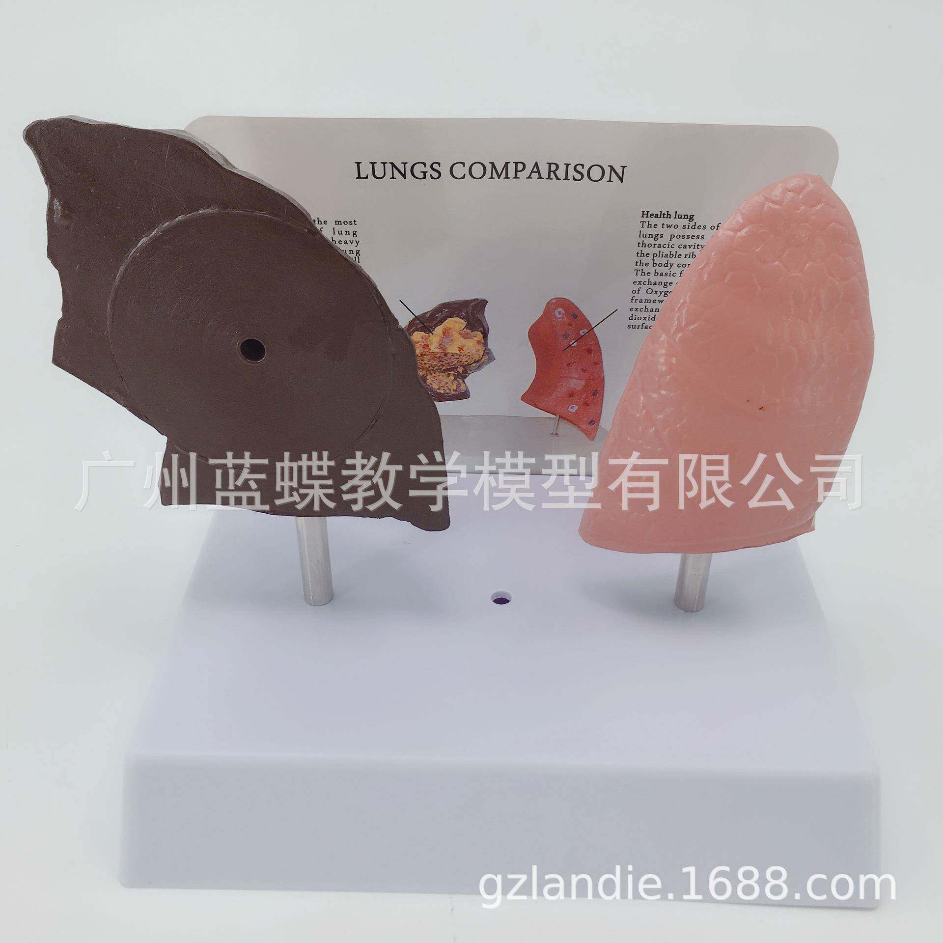 人体内脏健康肺与病态肺比较模型 正常肺解剖模型 病理肺对比模型