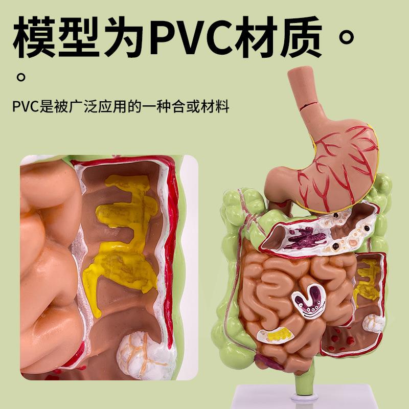 人体胃冠状剖面解剖放大 病理胃模型 胃的穿孔 病态胃模型消化科