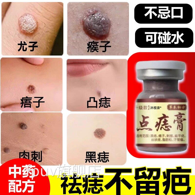 点痣痦子膏去脖子小肉粒尤猴去除抑菌液腋状下皮扁平尤祛丝尤FPUV