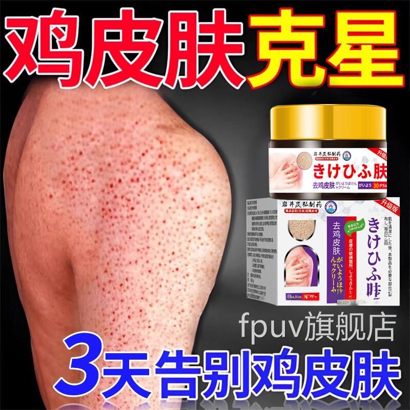 日本去鸡皮肤鱼鳞疙瘩毛囊除角化症角质膏用手臂身体去器永FPUV旗