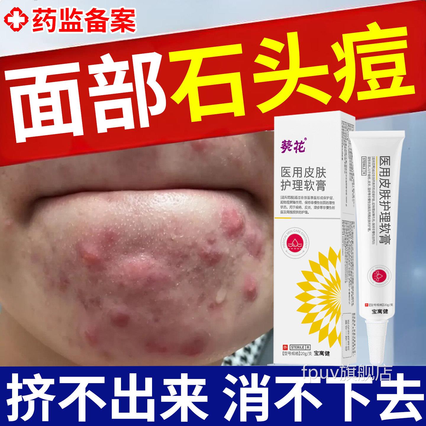 祛石头痘下巴反复长痘节痤疮皮脂腺结硬块痘痘去红肿囊肿脓包药膏