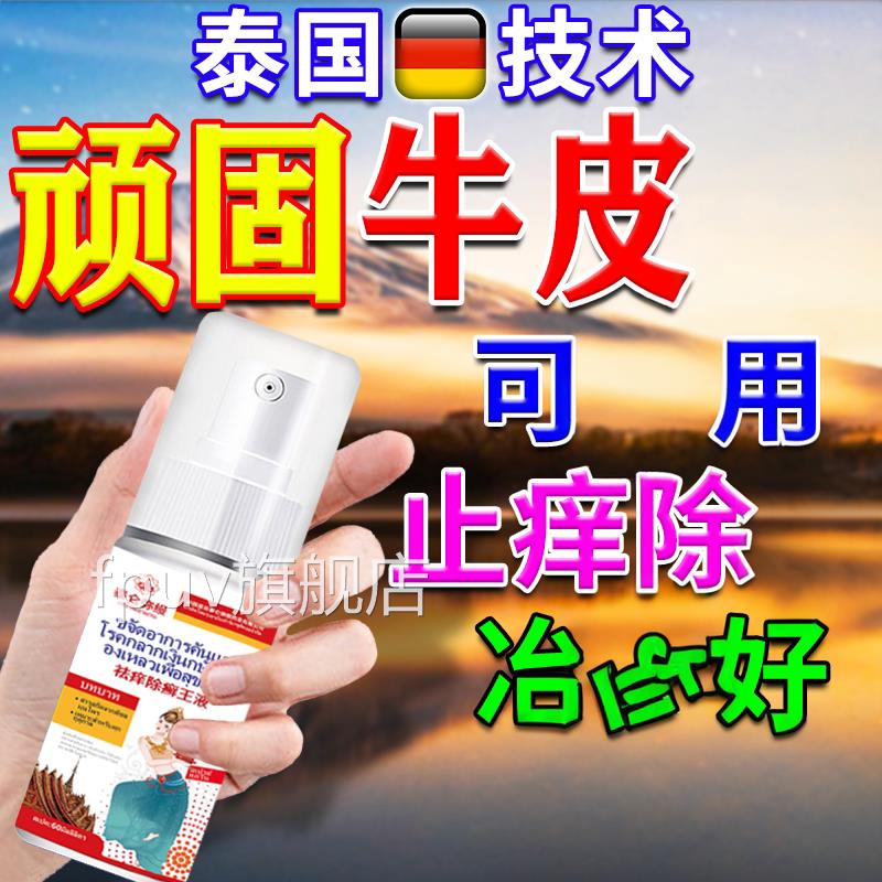 进口牛皮银屑病用膏药正品杀菌止根皮痒肤体股瘙特痒效去喷剂FPUV