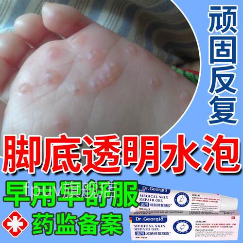 脚上底汗泡疱疹去脚底起水泡又痒又脱皮瘙痒根止痒专用药小膏u9旗