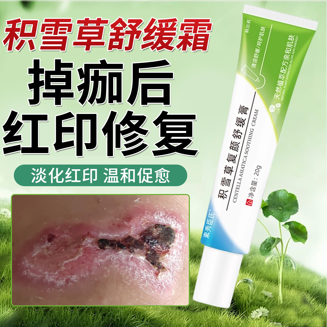 积雪苷霜软膏淡化掉痂后红印修复图片