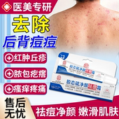 后背长痘痘去除毛囊炎马拉色菌前胸背上祛痘喷雾除螨痒背部背后QF