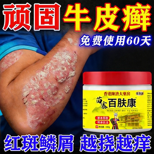 顽固牛皮癣银屑病效特否药膏皮肤用头皮外用真菌感染皮肤脱皮干裂