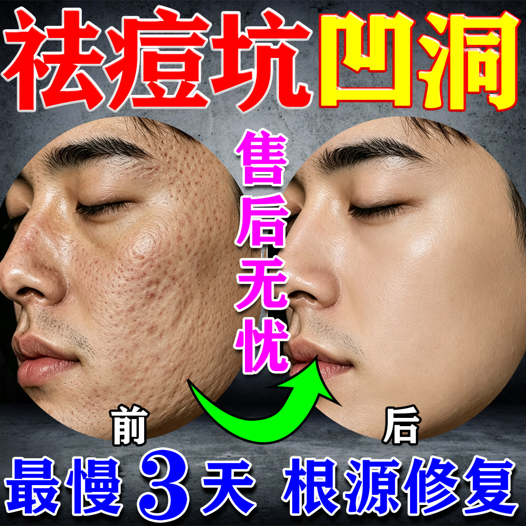 祛痘印痘坑修复膏淡化去痘印痘疤