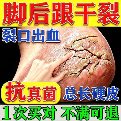 脚后跟干燥开裂治脚裂第一名