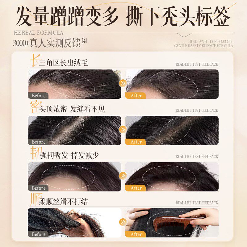 OHBT澳白防脱育发液男女生头发际线快速增长营养液剂增发密发生发