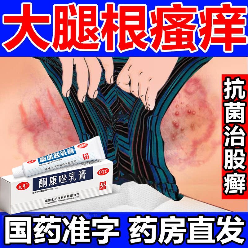治疗大腿内侧皮肤瘙痒癣痒股藓止癣症
