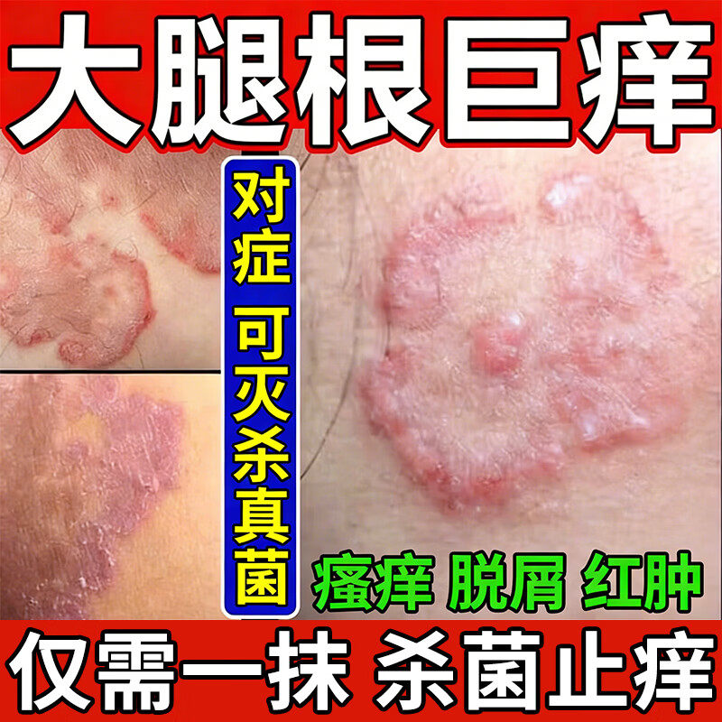 股癣专用药膏皮炎湿疹股癣大腿内侧外用抑菌藓真菌感染止痒药根膏