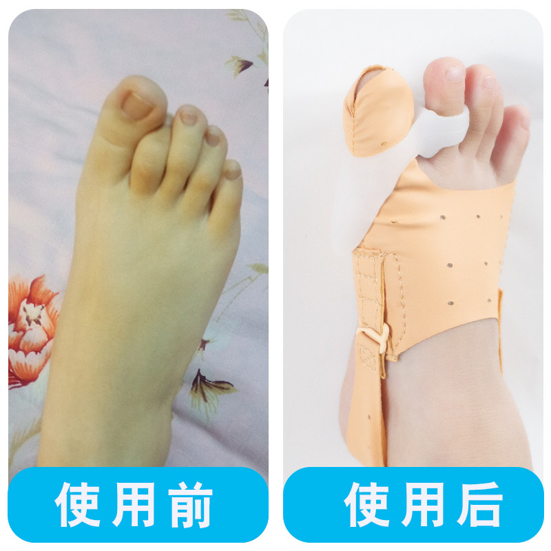 小孩子脚趾矫正器婴幼儿拇趾外翻矫形器宝宝分趾器重叠趾分离器内
