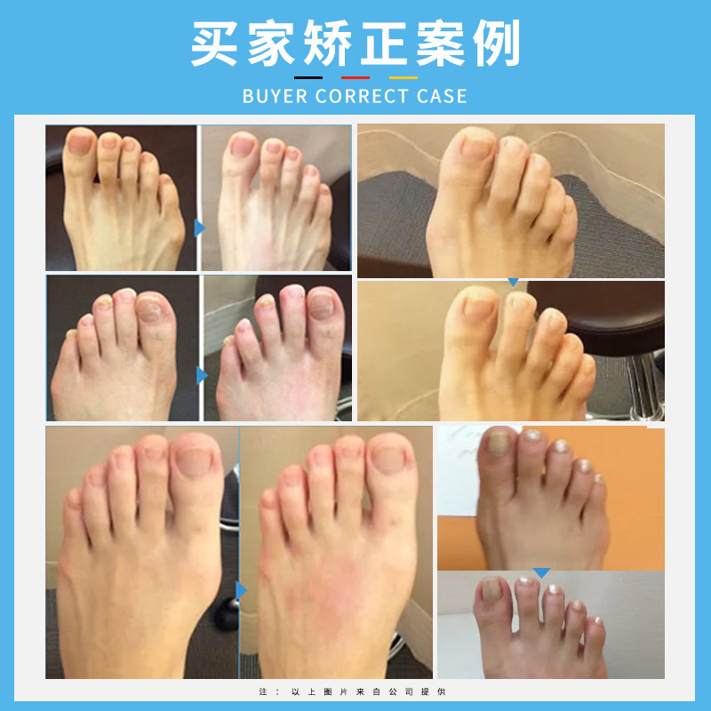 大脚趾外翻矫正器拇指外翻矫形器分趾器男女士分离大脚骨纠正支架