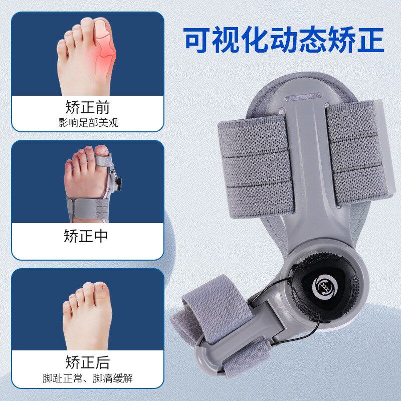 脚趾头大拇指外翻矫形器日夜用矫正大脚骨拇指娇正器旋钮拇外翻器