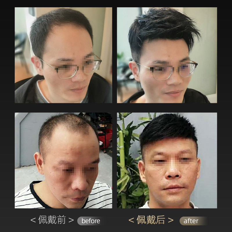假发男补发男短发男士头顶中年补发真发手织补发片块头顶脱发补发