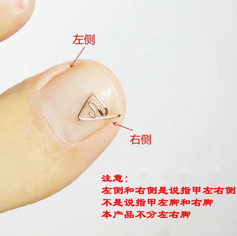 宗健嵌甲单侧矫正丝器 矫形片 拇指小趾2345指甲扎肉卷曲变形甲沟