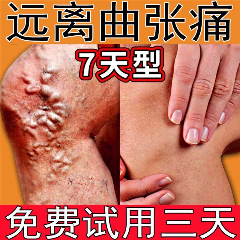 【云南本草正品】去除静脉精索曲张修复腿部酸胀青筋凸起专用药