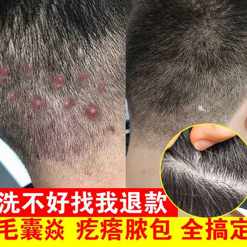 同仁堂氨基酸毛炎宁洗发水头皮毛囊除螨去痘痘去屑止头痒控油蓬松