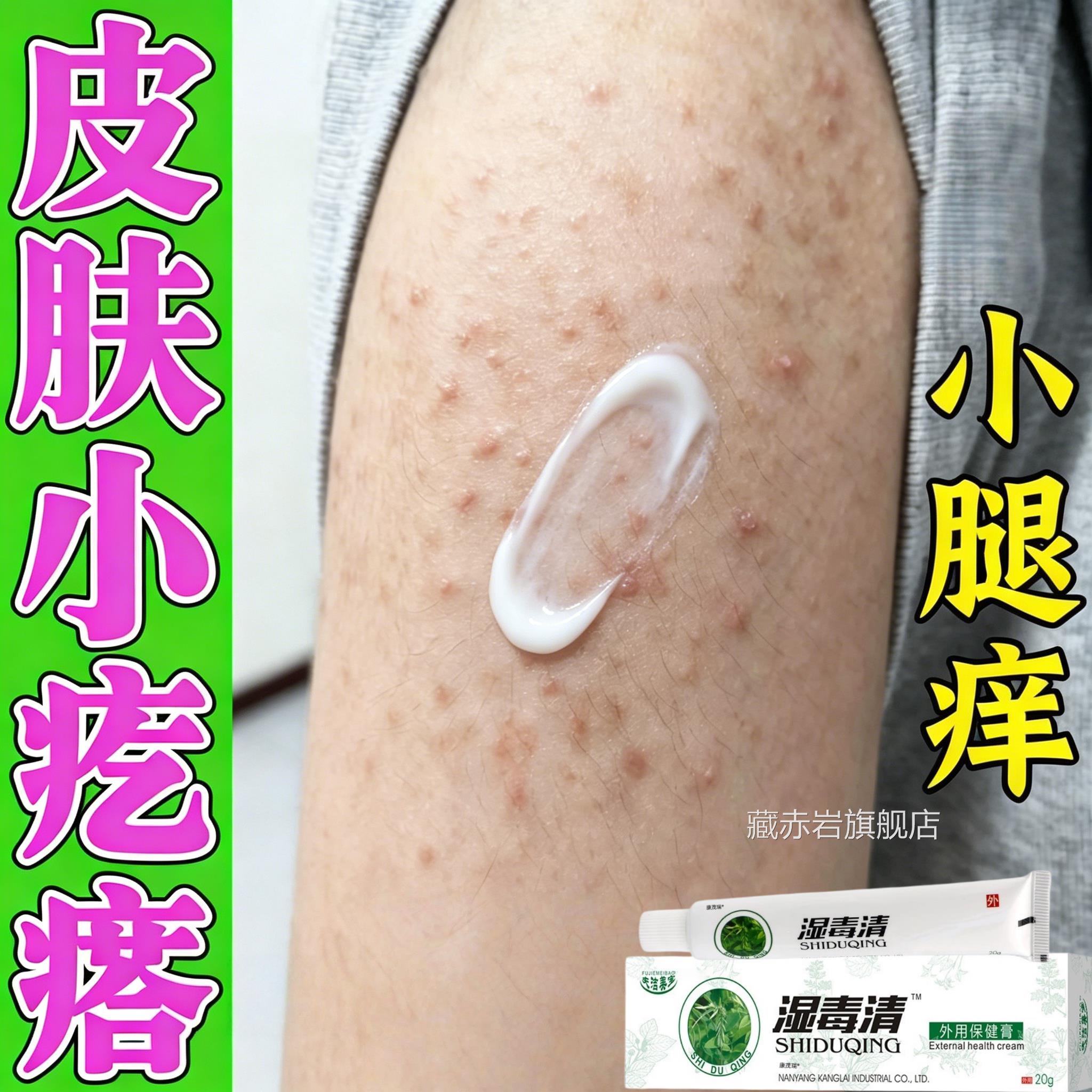 夏天小腿痒湿成人止皮膏出汗身上痒天热肤瘙痒热疙瘩红疹热毒颜慈
