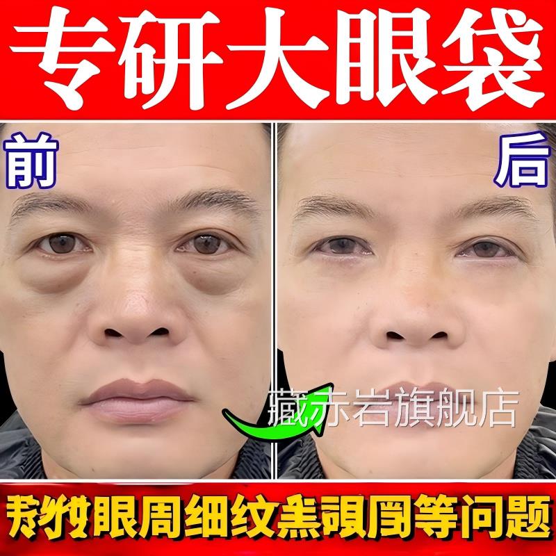 眼袋排肿膏去消液严重肿强力眼消除袋神男士器一分钟克专用霜星颜