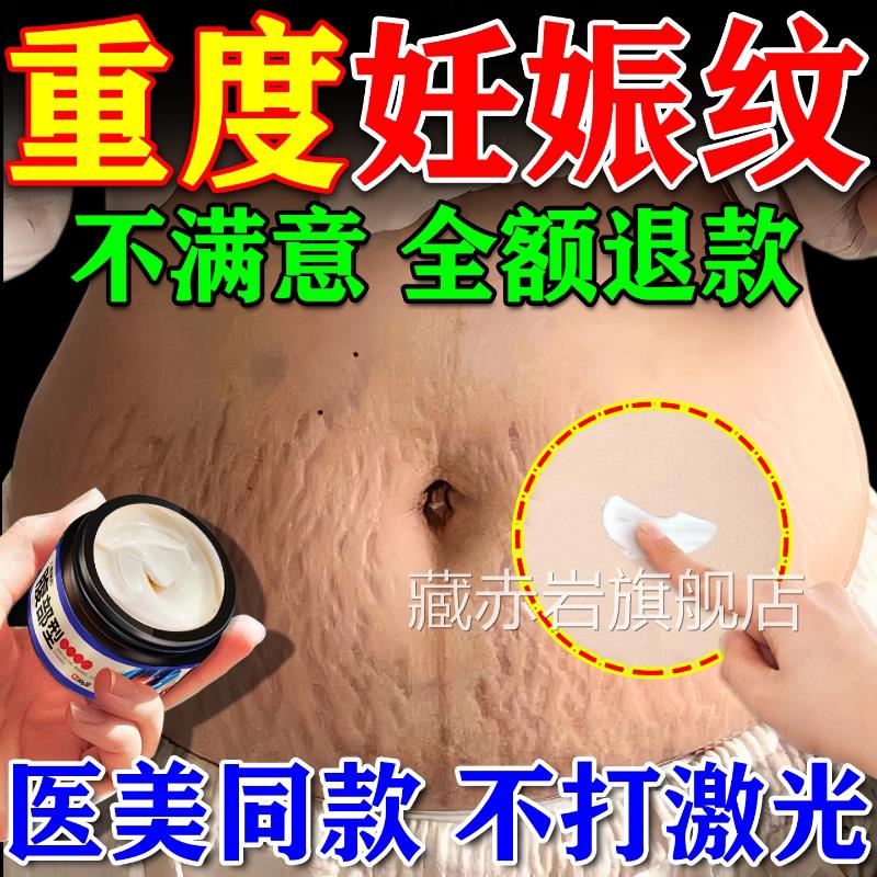 去妊辰纹消除妊娠纹非紧致肚皮非修复霜非淡化除疤痕膏遮盖神器藏