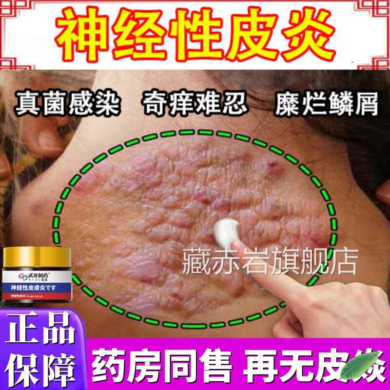 神经性皮炎特药效根去外用感膏治除皮肤病癣藓湿疹真菌染顽固疗30