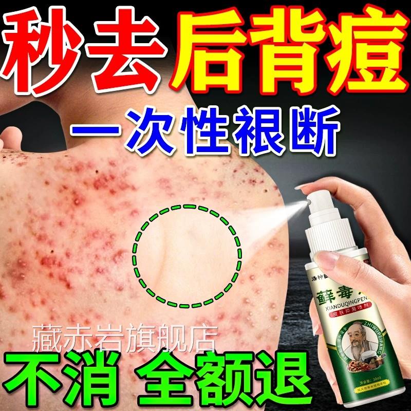 后背祛痘喷雾去除前胸痘背上痘螨虫毛囊炎疙瘩痤疮止痒效特喷剂药