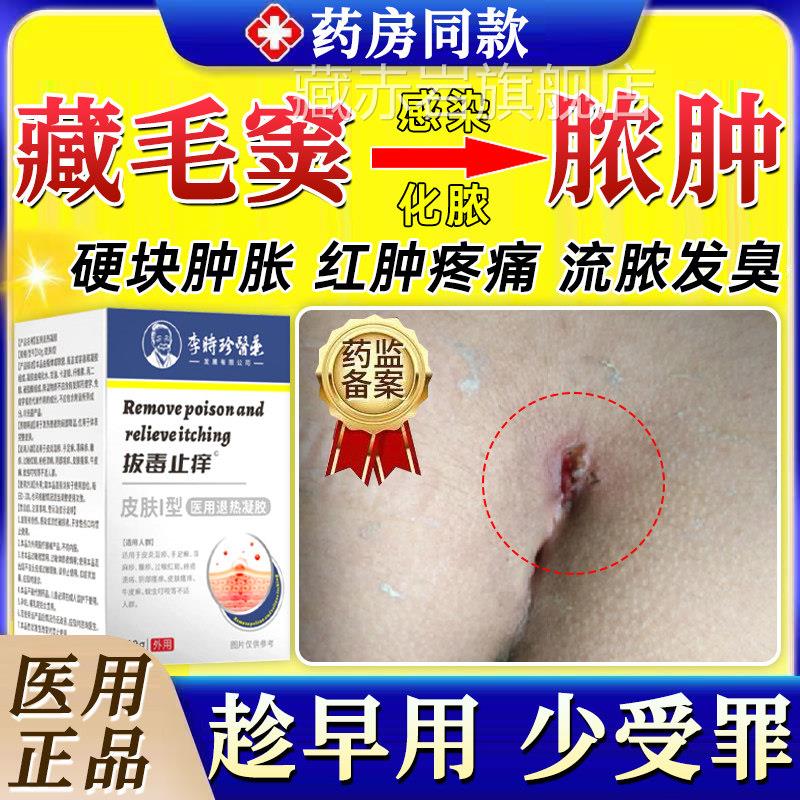 藏毛窦药膏感肛染化脓脓肿囊肿骶骨尾门硬疙瘩坐疮毛囊炎拔毒拔GX