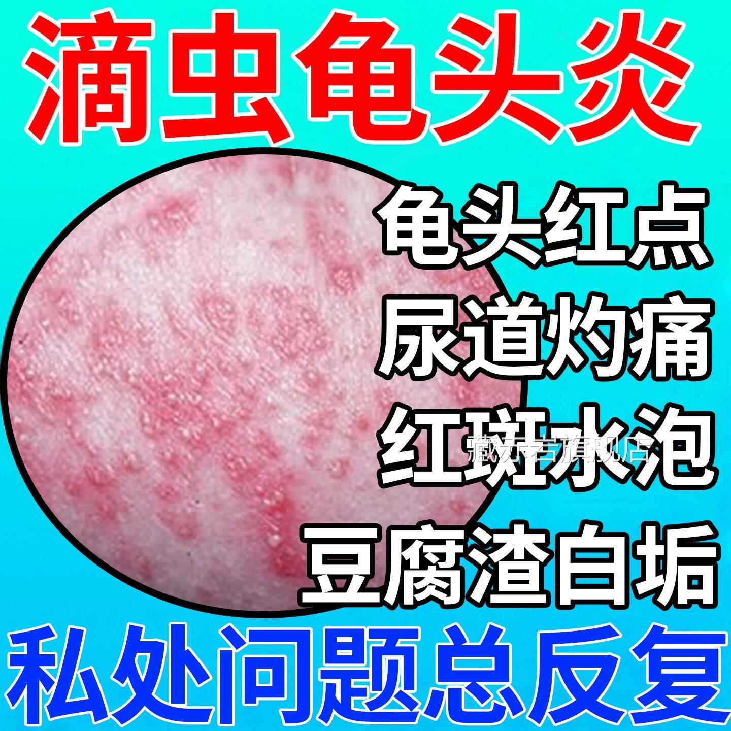 滴虫性龟头炎症龟头小红点尿道灼疼痛皮红斑水泡包下面豆腐渣白垢