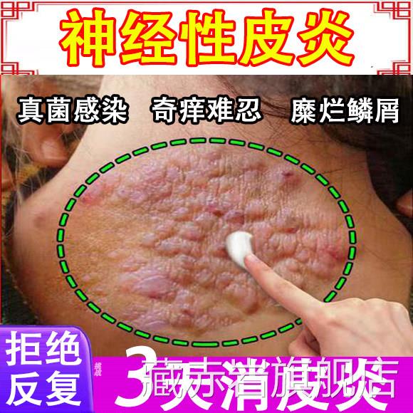 神经性皮炎特药效根去外用膏治疗皮肤病癣藓湿疹真菌除感染顽固W