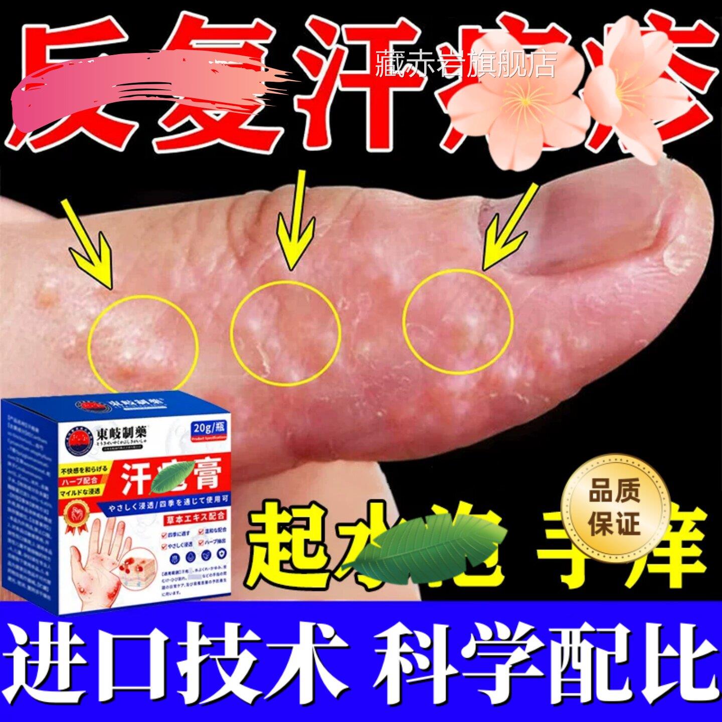 手上起小水泡汗状疱湿痒疹带状真杀菌感染止手气脱皮痒专去疹用膏