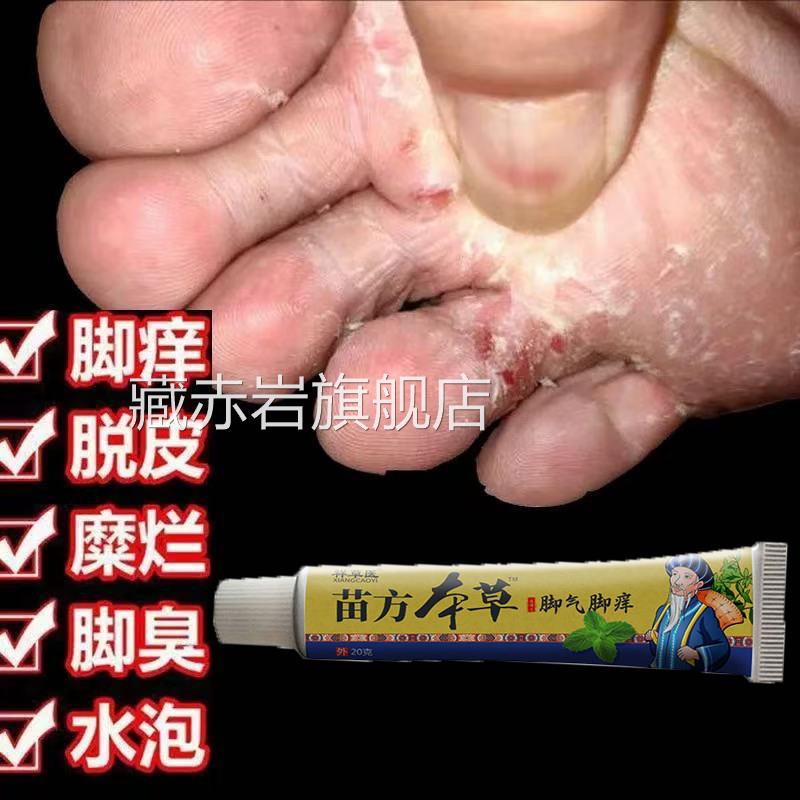 脚气膏抑菌专用止痒皮杀脱菌臭脚出汗真菌专用烂脚丫脚趾缝糜烂痒