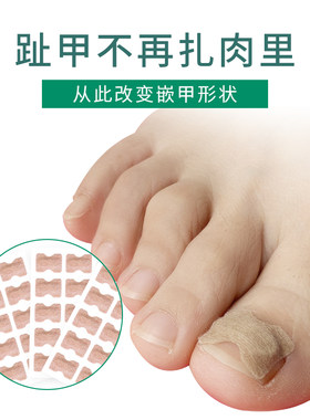 和才免胶水正甲贴甲沟嵌甲矫正贴片器脚趾甲长肉里指甲扎拉拉炎纠
