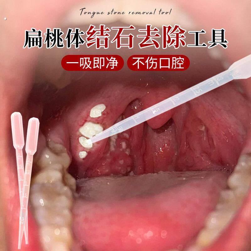 扁桃体结石去除工具取出隐窝神器扁导体石清理器口腔扁条体扁桃腺