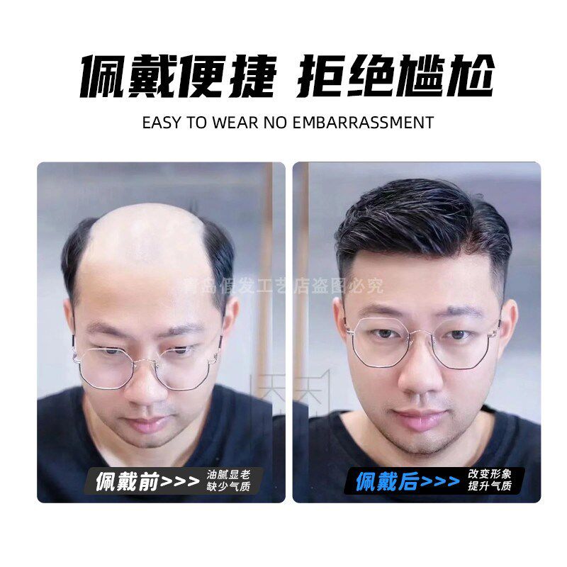 假发男士头顶前额全头套生物头皮全递针真发发际线假发贴隐形定制
