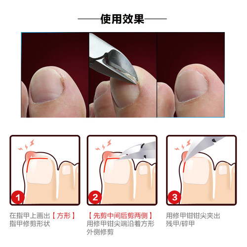 韩国777甲沟内嵌甲钳 足部灰厚硬脚趾甲鹰嘴钳修脚指甲剪刀炎护理