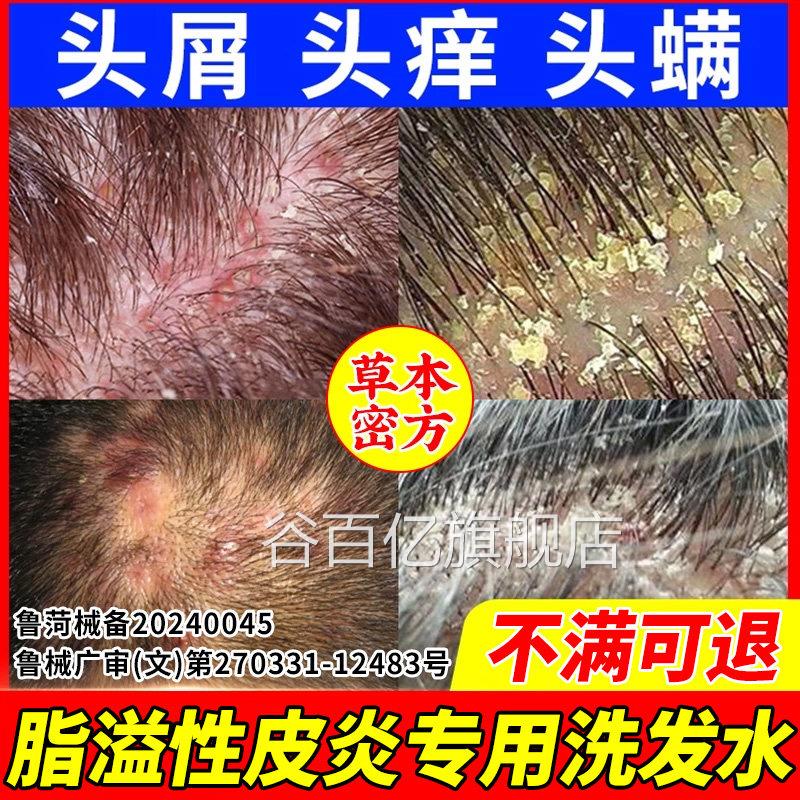 脂溢性皮用炎毛洗发水去屑止痒抑菌面部专头皮马拉色真菌感染头癣