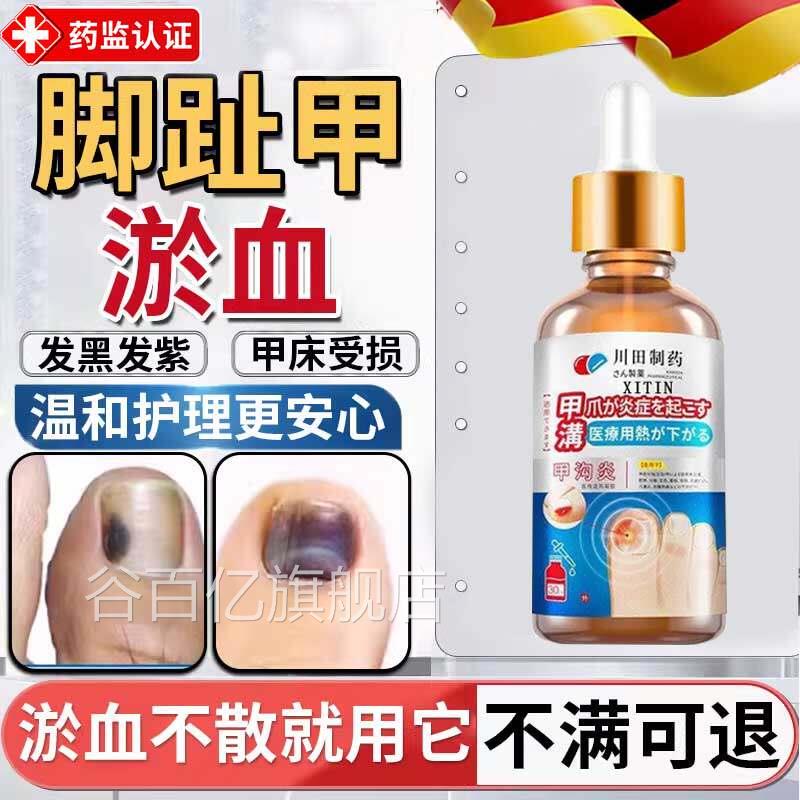 甲沟炎脚趾甲被砸指甲被夹甲床淤受损甲下血发紫发黑真菌感染ZT谷