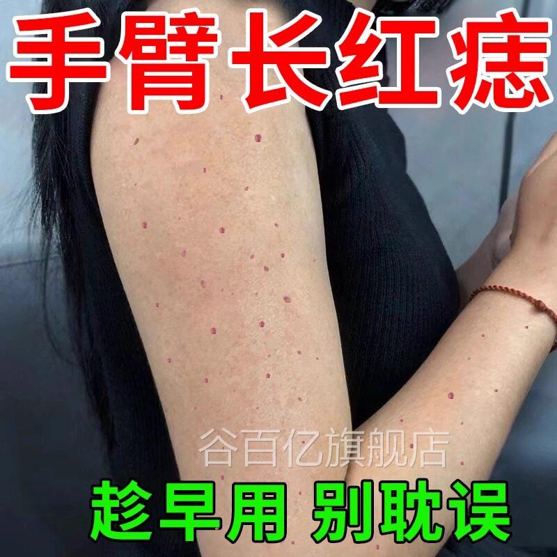 血管瘤药膏樱桃状痣点脖子胸口红痣血痣蜘蛛痣去除身上红点套装GX